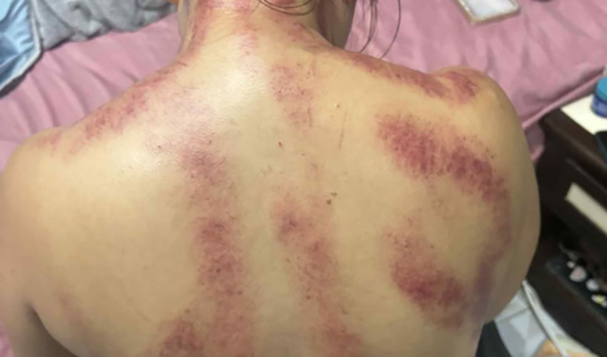 Gua Sha’s Benefits